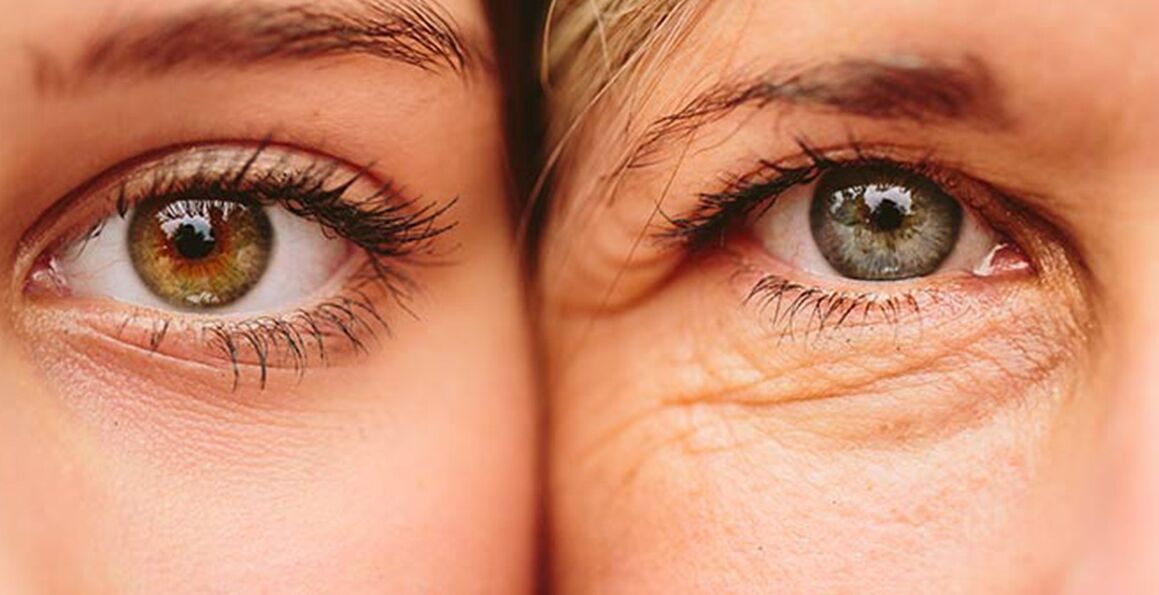 Shenjat e jashtme të plakjes së lëkurës rreth syve në dy gra të moshave të ndryshme
