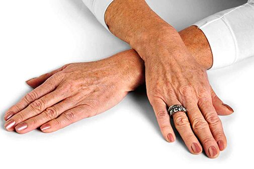 Lëkura e duarve me ndryshime të lidhura me moshën që kërkojnë përdorimin e teknikave të rinovimit