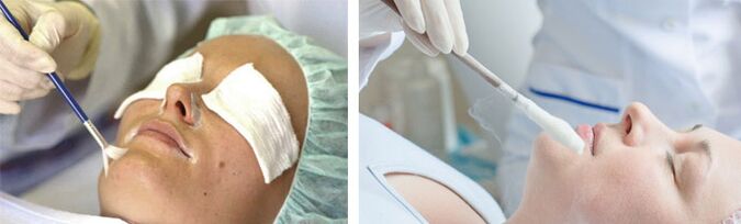 peeling dhe krioterapi për rinovimin e lëkurës