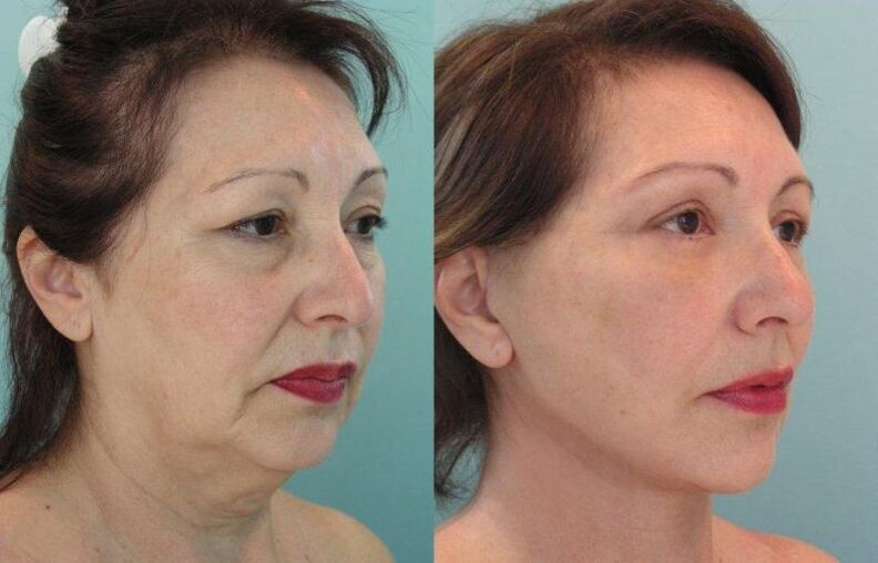 Rezultati i shtrëngimit rinovues të lëkurës së fytyrës me fije